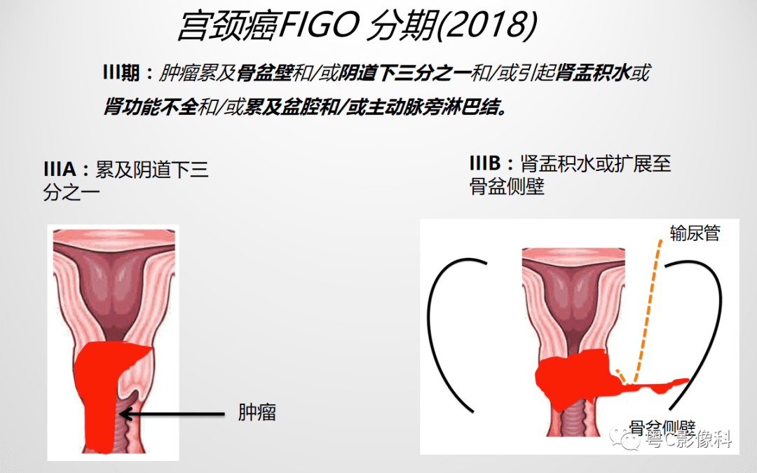 压疮最新分期及其观点论述摘要